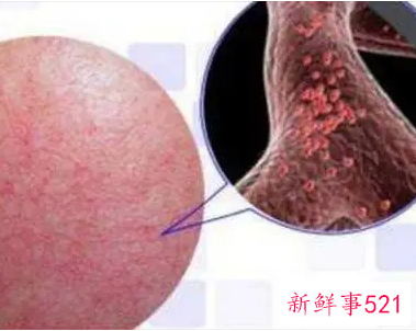 皮肤敏感发红发热怎么补救