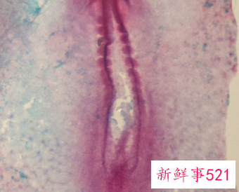 外阴白斑是什么样的