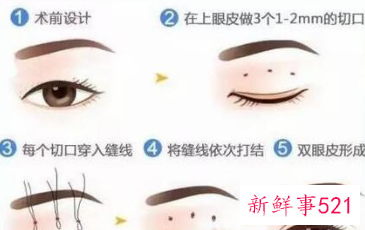 各种脸型适合的双眼皮