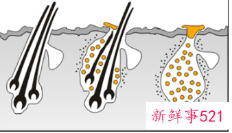 一般植发能维持多久
