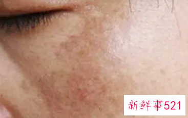 为什么脸上会长色素斑呢
