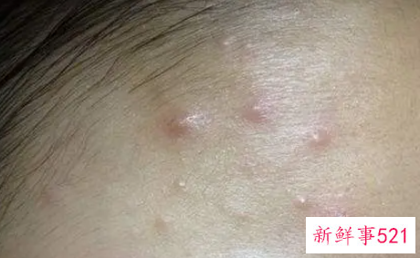 额头长痘怎么去除