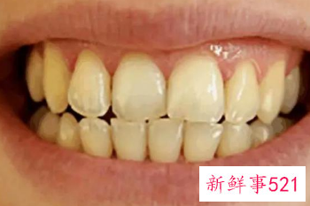 每天都刷牙牙齿还是越来越黄