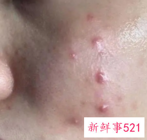 怎么解决脸上痘痘问题