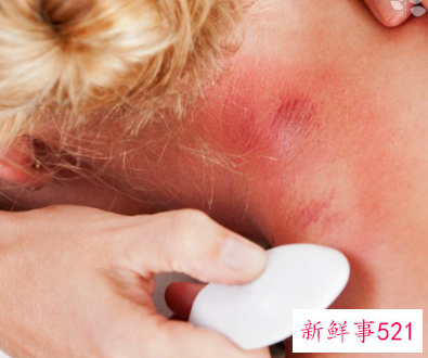 皮肤敏感发红发热怎么补救