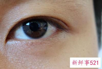 眼睛旁边的脂肪粒怎么去除小妙招