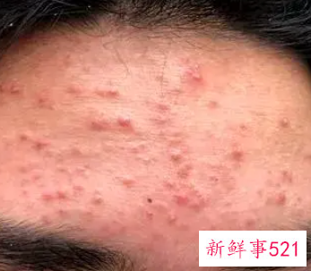 怎么解决脸上痘痘问题