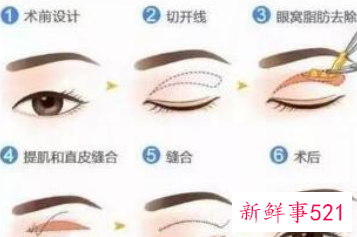 各种脸型适合的双眼皮