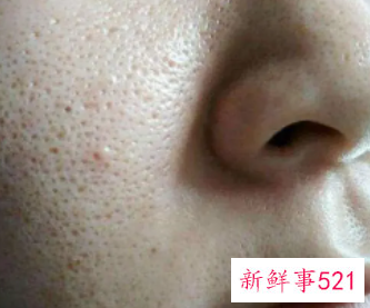 怎么解决脸上痘痘问题