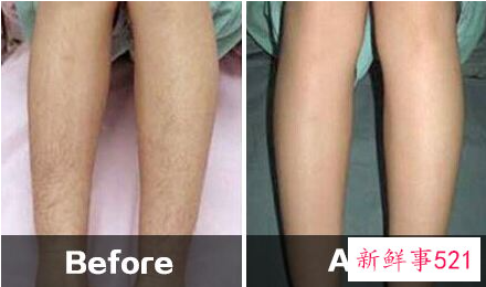 12岁女生去腿毛小妙招