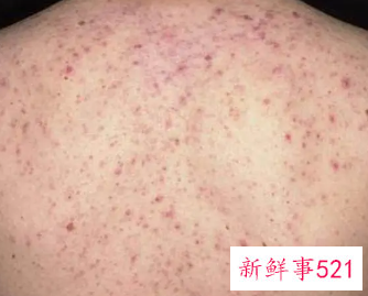为什么背上和胸前长痘痘
