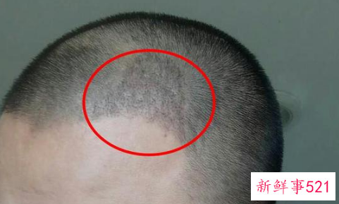 一般植发能维持多久