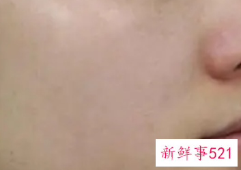 激光祛斑和超皮秒哪个效果好