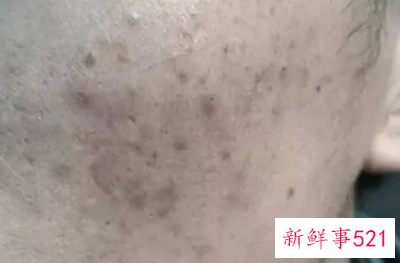 如何淡化黑痘印