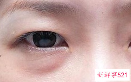 眼袋与卧蚕的区别