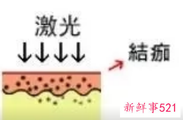 皮肤损伤色素沉着修复方法