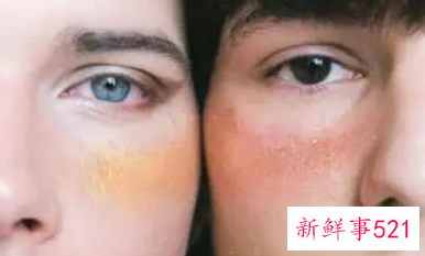 为什么脸上会长色素斑呢