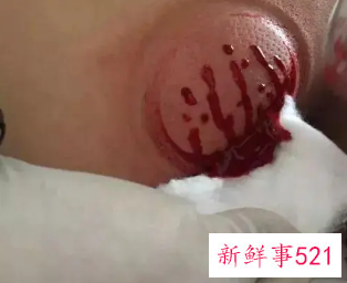 女生背部放血有啥好处