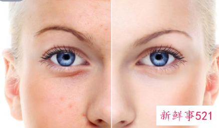 祛斑后色沉用什么方法可以消除