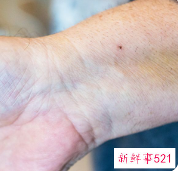 突然长包像蚊子咬的超级痒