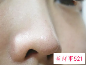 挤完黑头收缩毛孔最佳方法