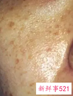 脸上色斑越来越多是怎么回事