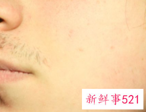 挤完黑头收缩毛孔最佳方法