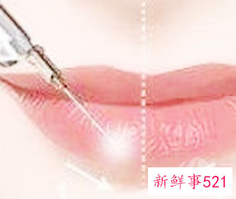 嘴角纹去除最好的方法是什么