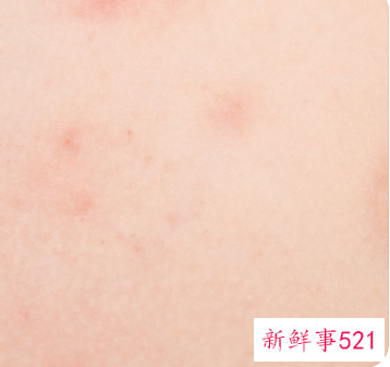 突然长包像蚊子咬的超级痒