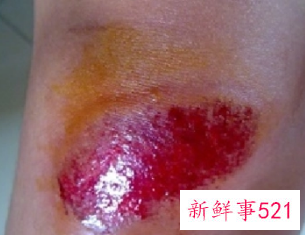 擦伤看见肉了怎么处理