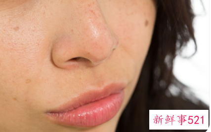 祛斑后色沉用什么方法可以消除