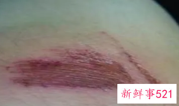 擦伤看见肉了怎么处理