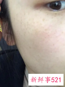 脸上色斑越来越多是怎么回事