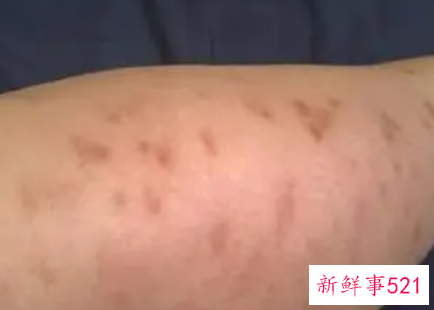 梦见生疥癣有什么征兆