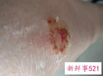 擦伤看见肉了怎么处理