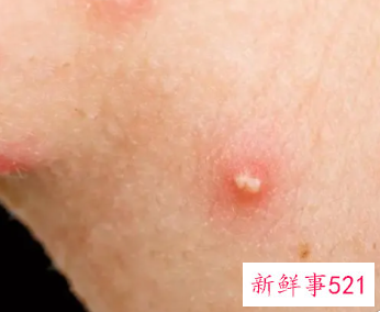 痘痘里的白色脓是什么