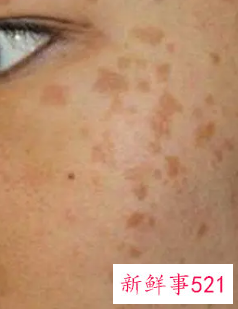 脸上色斑越来越多是怎么回事