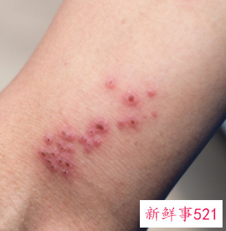 突然长包像蚊子咬的超级痒