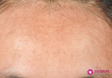 天生的额头纹可以去掉么