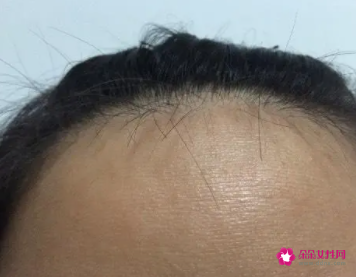 天生的额头纹可以去掉么