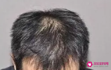 秃顶的原因及治疗方法