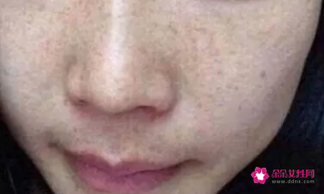 脸上长斑是咋回事