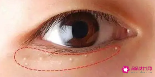 用眼霜会长脂肪粒的原因