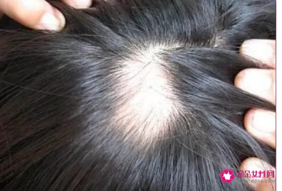 秃顶的原因及治疗方法