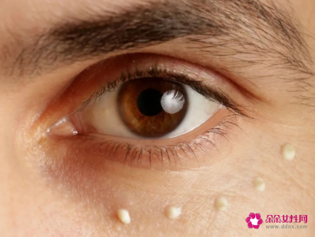 用眼霜会长脂肪粒的原因