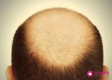 秃顶的原因及治疗方法