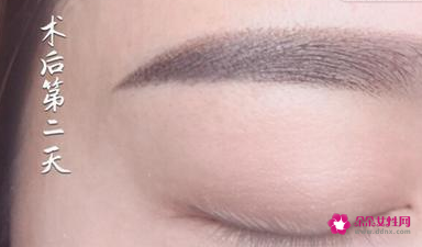 绣眉后1至7天的变化