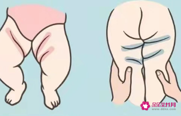 四个月宝宝腿纹不对称有什么影响