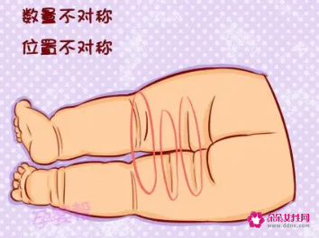 四个月宝宝腿纹不对称有什么影响