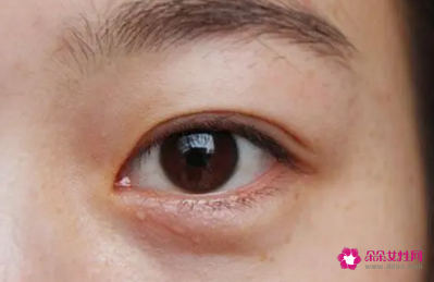 脂肪粒怎么消除在眼角